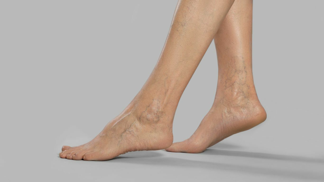How do you treat varicose veins in the legs